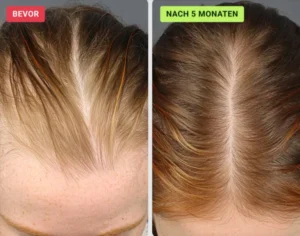 HaloGrow Hair Spray Customer Reviews